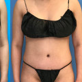 The Truth About Pain in Liposuction and Tummy Tuck Procedures