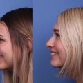 Mastering the Art of Rhinoplasty: The Complexities of the Most Difficult Plastic Surgery